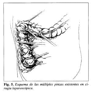 Pinzas Existentes en Cirugía Laparoscópica