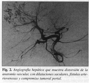 Angiografía Hepática que muestra distorsión de la Anatomía Vascular