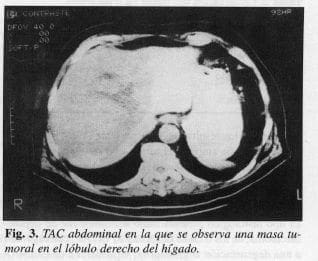 Masa Tumoral en el Lóbulo derecho del Hígado