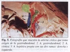 Arteria Cística que toma origen de la Gastroduodenal