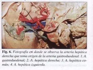 Arteria Hepática derecha que toma origen de la Arteria Gastroduodenal