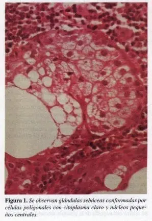 Células Poligonales con Citoplasma Claro y núcleos Pequeños Centrales