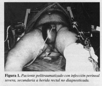 Paciente Politraumatizado con infección Perineal Severa