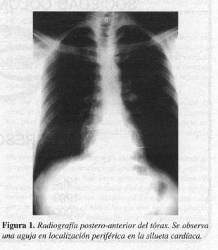 Radiografía postero-anterior del Tórax
