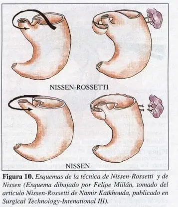 Esquemas de la técnica de Nissen-Rossetti