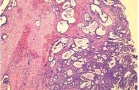 Mucosa de la vesícula biliar