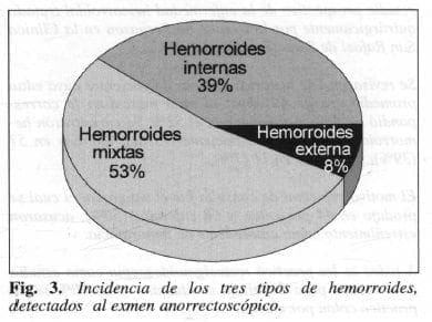 Tres Tipos de Hemorroides
