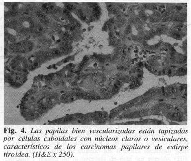 Células Cuboidales con Núcleos Claros o Vesiculares