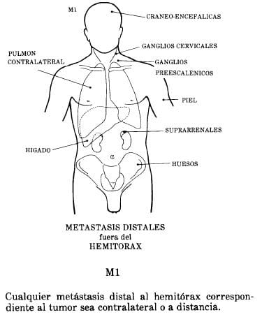 Metástasis Distal al Hemitórax