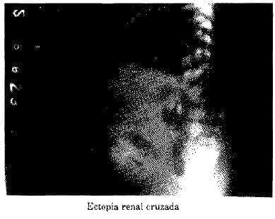 Ectopia Renal Cruzada