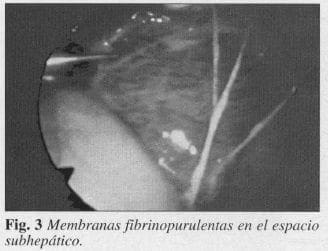 Membranas Fibrinopurulentas