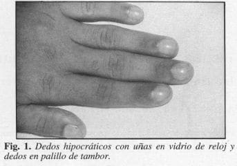 Dedos Hipocráticos con uñas en Vidrio