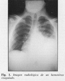 Imagen Radiológica de un Hemotórax Coagulado