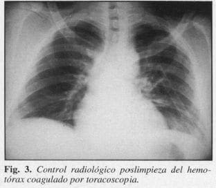 Control Radiológico Poslimpieza del Hemotórax