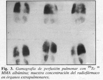 Gamagrafía de Perfusión Pulmonar