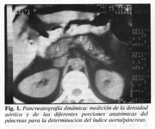 Medición de la Densidad Aórtica del Pancreas
