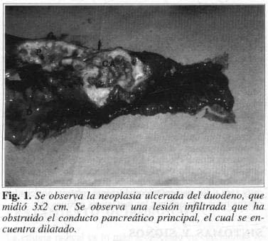 Neoplasia Ulcerada del Duodeno