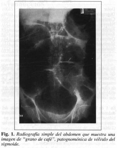 Radiografía Simple del Abdomen