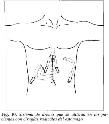 Sistema de Drenes