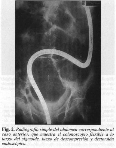 Abdomen, Colonoscopio Flexible a lo largo del Sigmoide