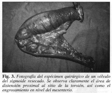 Espécimen Quirúrgico de un Vólvulo del Sigmoide Resecado