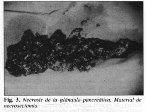 Necrosis de la Glándula Pancreática