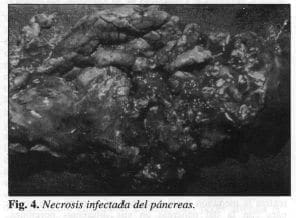 Necrosis Infectada del Páncreas