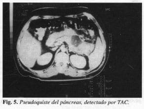 Pseudoquiste del páncreas, detectado por TAC
