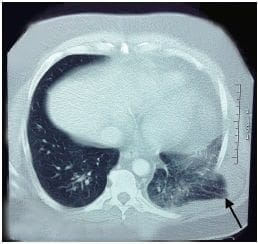 Protrusión del pulmón