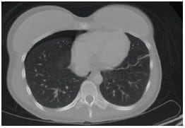 Tomografía axial de abdomen