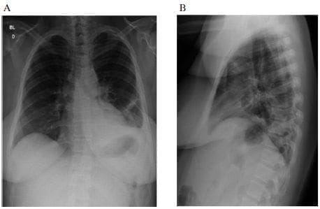 Radiografía de tórax posoperatoria