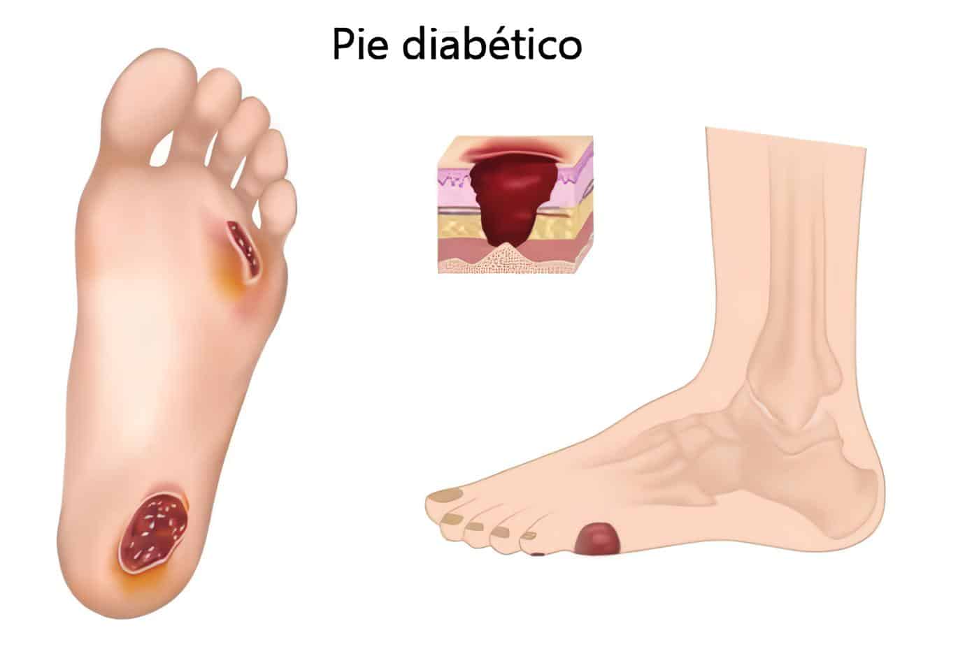 Paciente con Pie Diabético