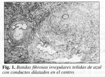 Bandas fibrosas irregulares