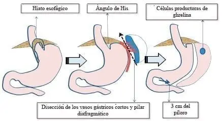 Gastrectomía laparoscópica