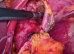 Disección del hiato esofágico