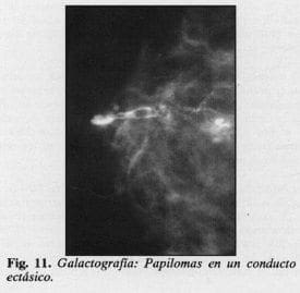 Galactografia: Papilomas en un conducto eclásico