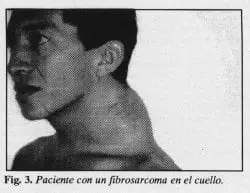 Fibrosarcoma en el cuello