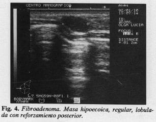 Fibroadenoma