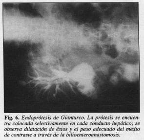 Endoprótesis de Gianturco
