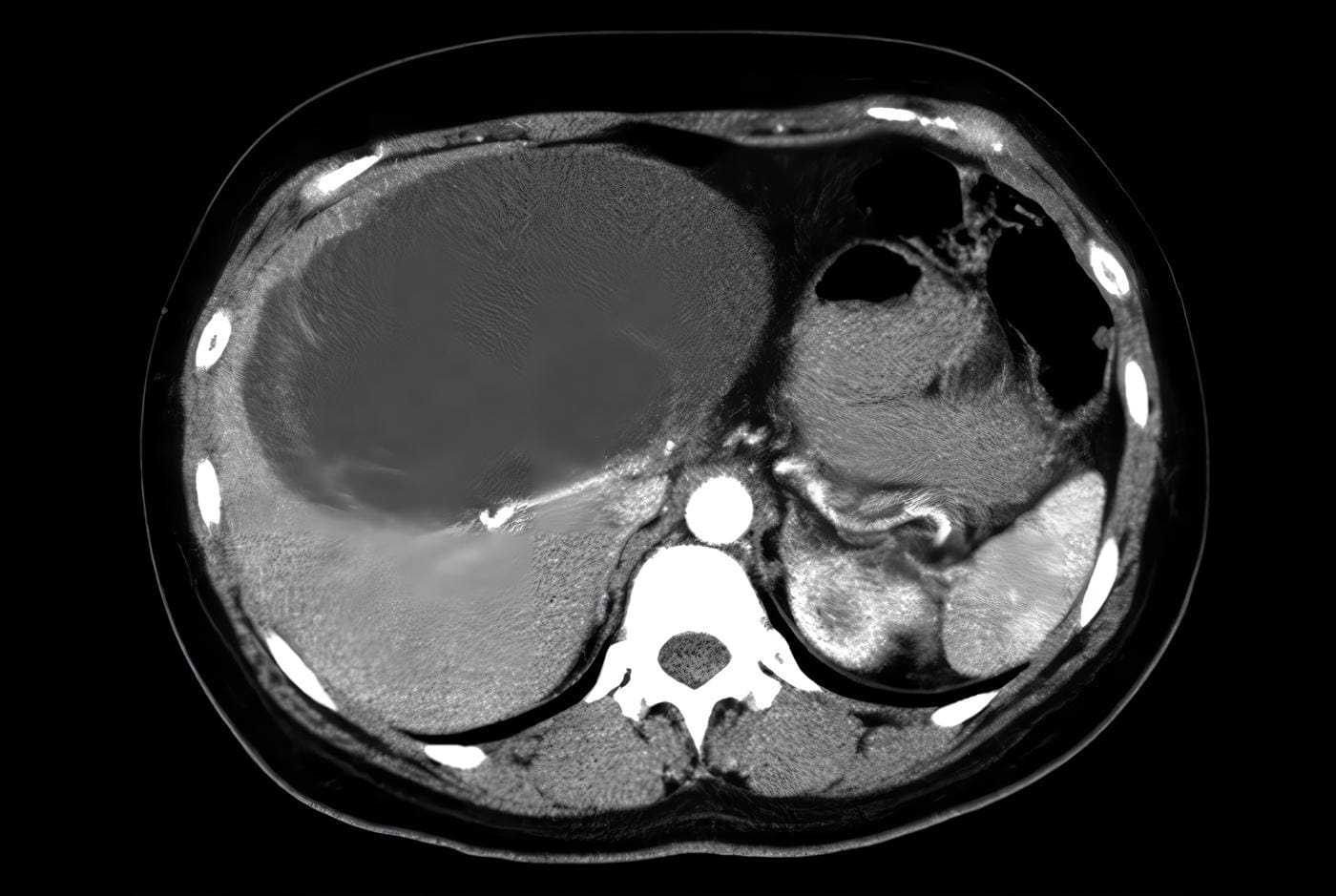 Hidatidosis Hepática