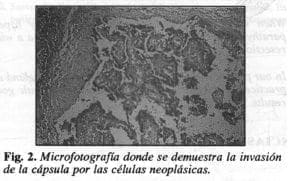Células neoplásicas