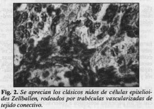 Nidos de células epitelioides