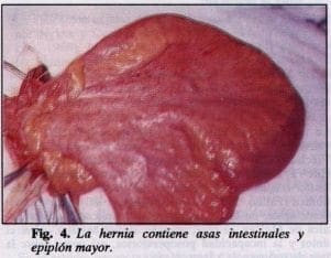 La hernia contiene asas intestinales