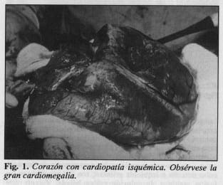 Corazón con cardiopatía isquémica - Trasplante Cardíaco