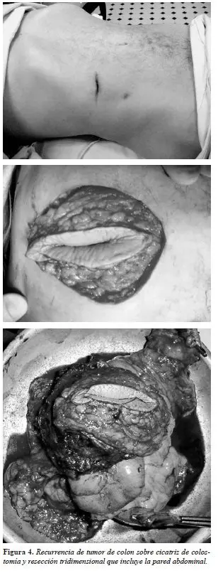 Tumor de colon sobre cicatriz de colos­tomía