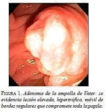 Adenoma de la ampolla de Vater