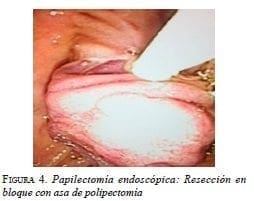 Papilectomía endoscópica