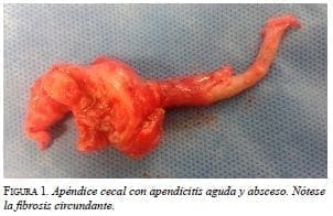 Apéndice cecal con apendicitis aguda