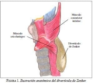 Divertículo de Zenker