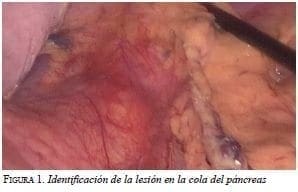 Lesión en la cola del páncreas